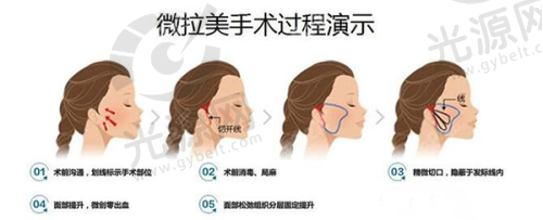 额头缩小手术的潜在后遗症有哪些？