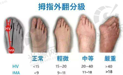 马桂文医生的手术技术——5D微孔祛大脚骨技术