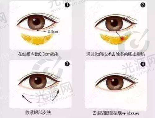总结:欧洲之星和热玛吉哪个好?慎重选择适合自己的抗衰方案