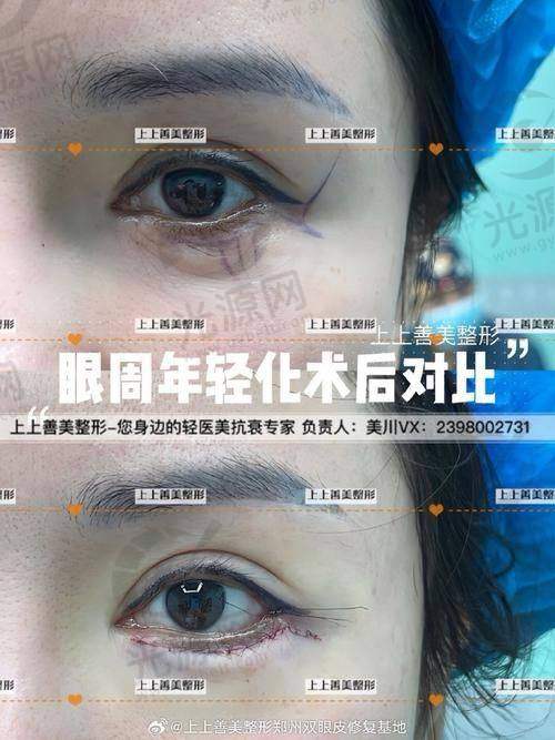 四、华美比较出名眼部医生口碑评价