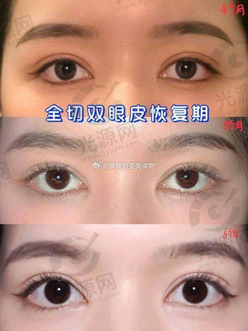 沈阳个双眼皮好的医生排名第二：杜继凤医生