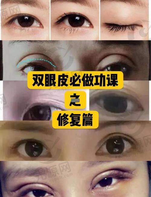 二、深圳割双眼皮医生排名详细介绍
