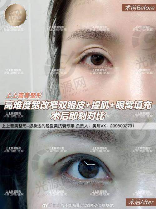 孙峰医生的手术费用：合理透明