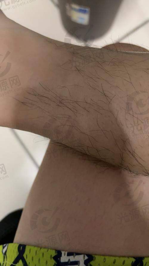 一、达州整形医院脱毛榜单前十名单