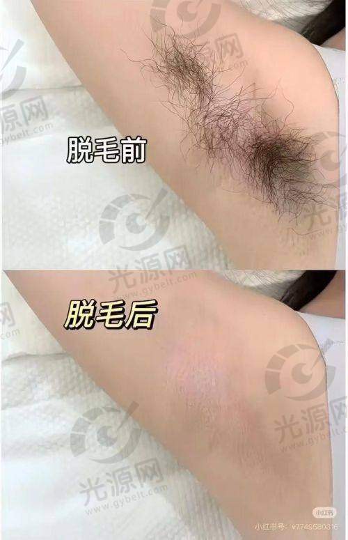 三、达州脱毛项目收费情况