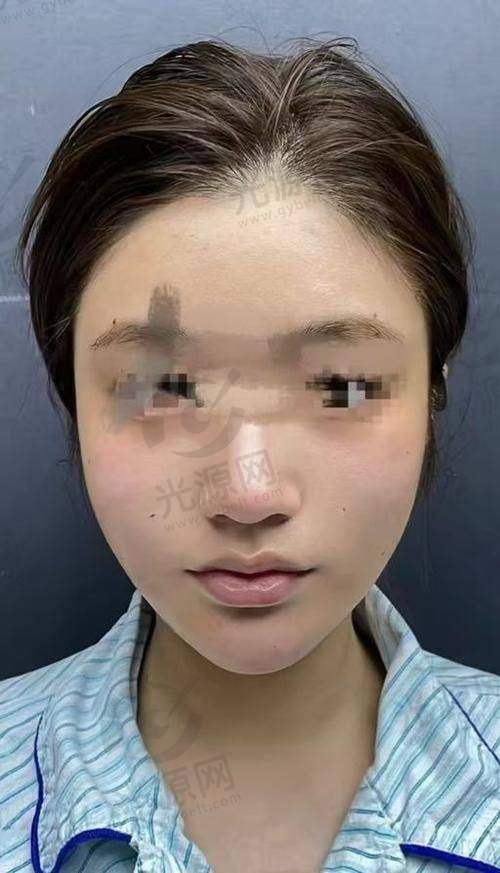 二、详细介绍西安自体脂肪填充医院