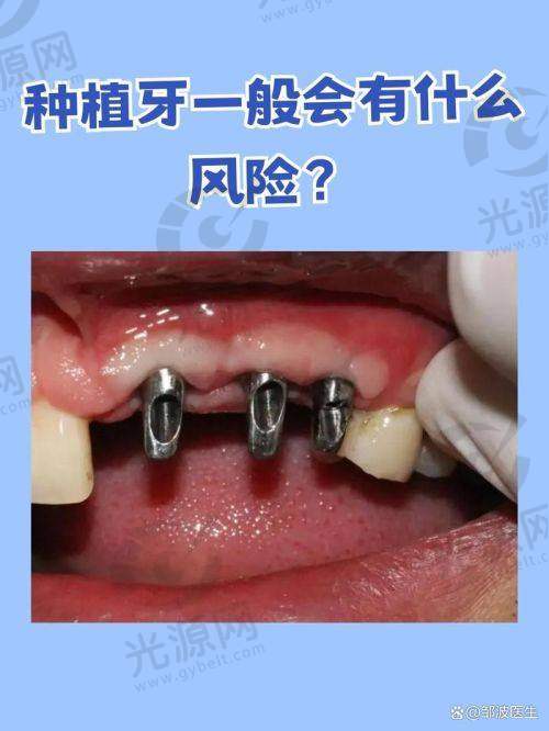 4. 牙齿修复项目价格