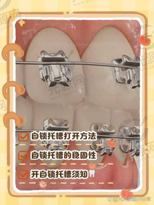 陶瓷牙套容易崩瓷
