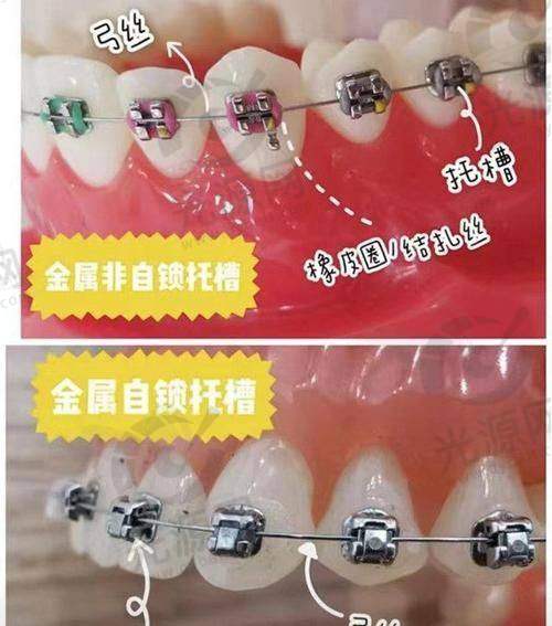 陶瓷托槽易脱落
