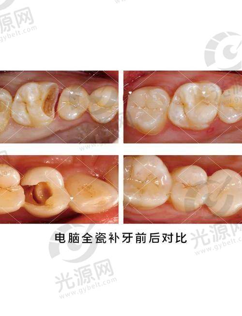 补牙后的牙齿护理