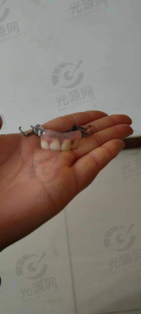 淘宝全瓷牙戴立克，成效与实际实例