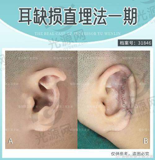 二、湘雅医院耳朵整形手术项目及技术优势