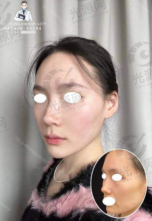 术后护理对挛缩的控制作用