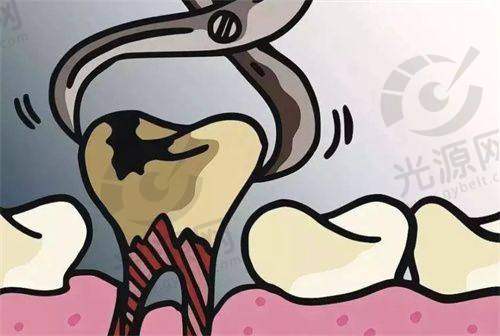 宁愿拔牙不做根管治疗的时间成本