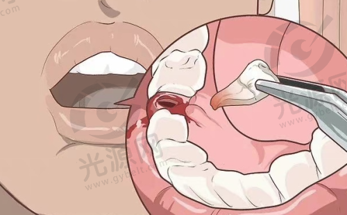 宁愿拔牙不做根管治疗的医生建议