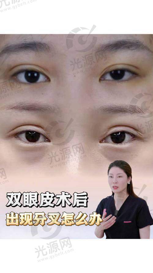 ME双眼皮手术的优势有哪些？