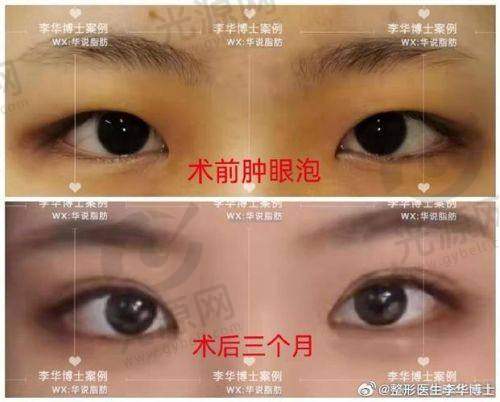 me双眼皮到底怎么做的？韩国ME双眼皮手术详解：操作过程、优缺点一览，了解美丽双眼皮的秘密！