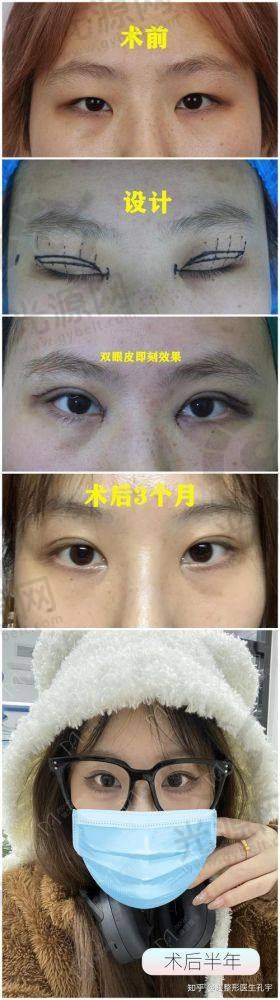 广州做双眼皮比较好的医生排名第二：吕方中医生