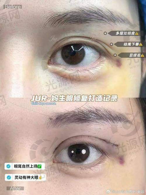 三、广州做双眼皮比较好的医生价格表