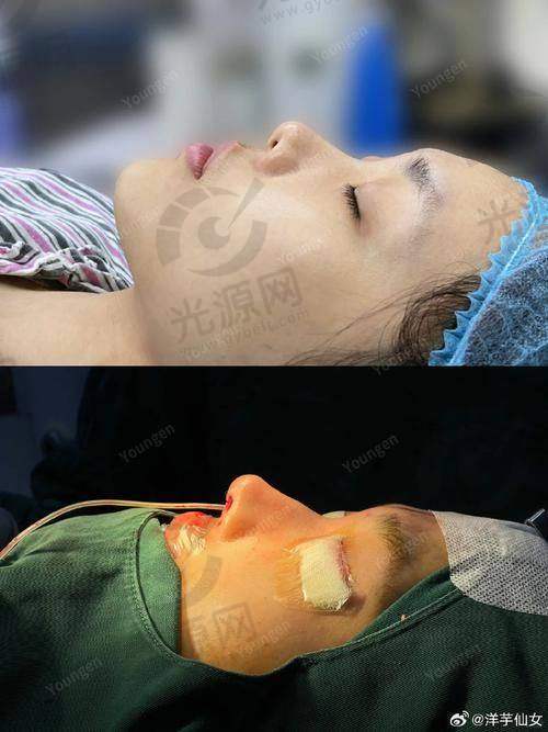 昆明做鼻子有名的医生排名第10：杨晓红医生
