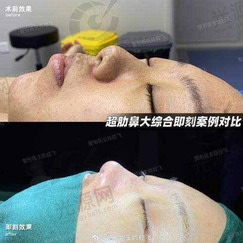 昆明做鼻子有名的医生价格表