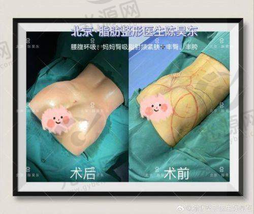 郑州抽脂比较好的医生排名第三：王一星医生