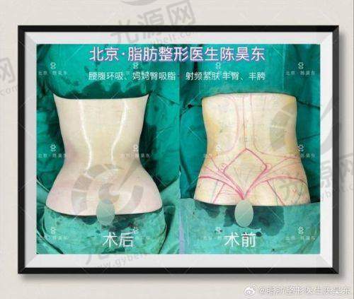 郑州抽脂比较好的医生排名第六：徐刚强医生