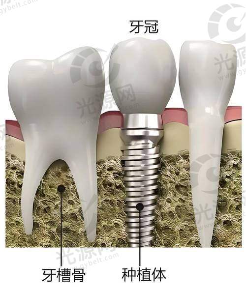 个性化基台的制作过程