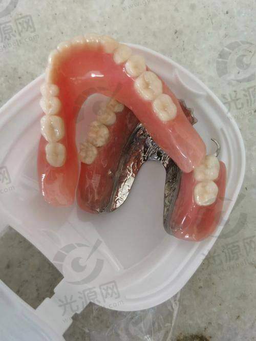 种植牙的价格与价值