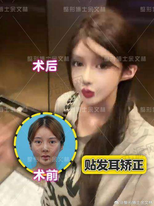 贴发耳矫正的潜在副作用
