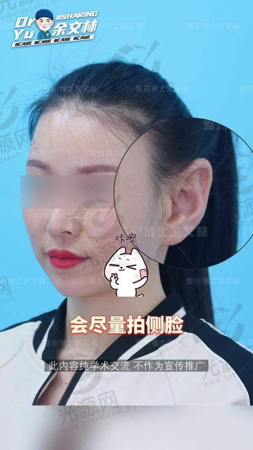 结语：贴发耳矫正手术的前景与选择