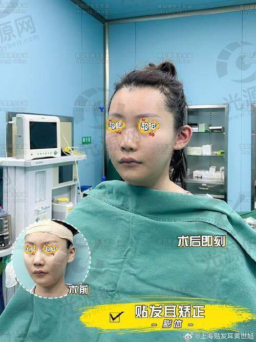 贴发耳矫正手术的成效与技术