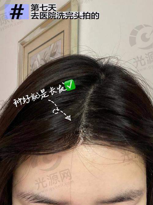 七、顺德植发医院收费明细