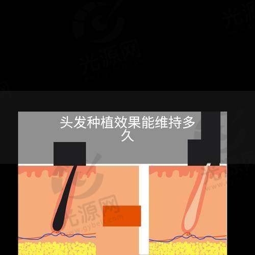 四、顺德植发医院口碑实例分享