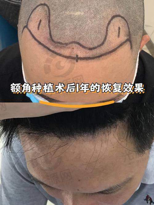 五、顺德植发医院详细信息