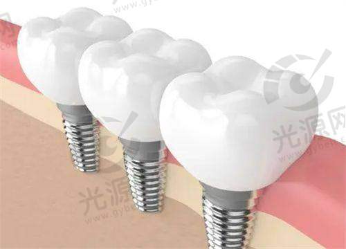 吉林大学口腔医院收费标准详细解析：种植牙、正畸、牙周治疗等项目价格一览！