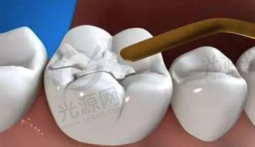 4. 泽山口腔医院补牙价格 - 全瓷牙