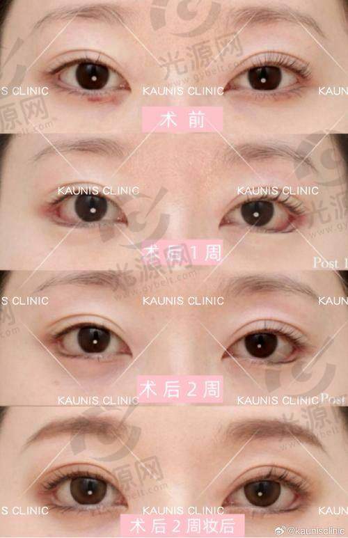 总结——选择割双眼皮的医生陈芝，成就美丽自信