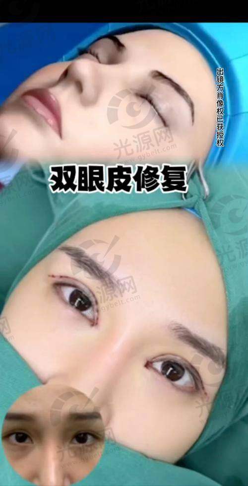 北京双眼皮修复医生排名第三：吴玉家医生