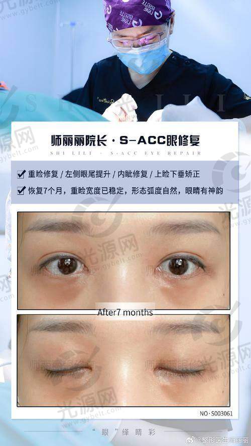四、北京双眼皮修复医生排名口碑评价
