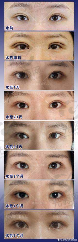北京双眼皮修复医生排名第九：谷廷敏医生