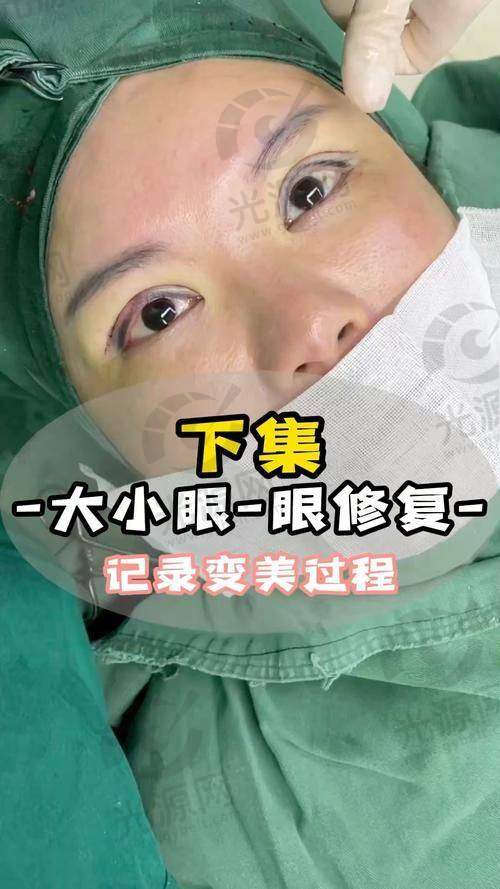北京双眼皮修复医生排名第七：张冰杰医生