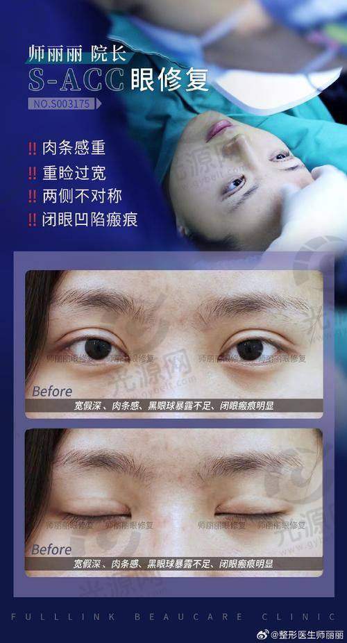 北京双眼皮修复医生排名第二：郭峰医生
