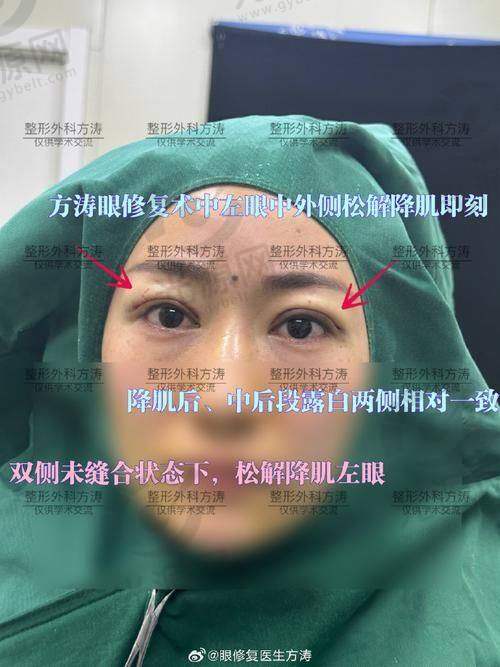 三、北京双眼皮修复医生排名价格表