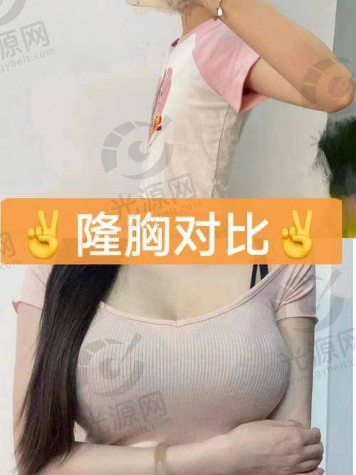 如何护理假体隆胸后的引流液