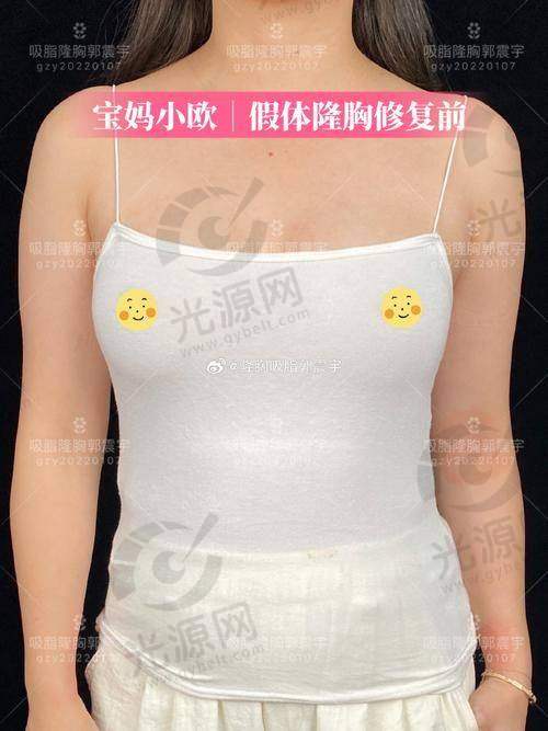 不放引流管的优缺点分析