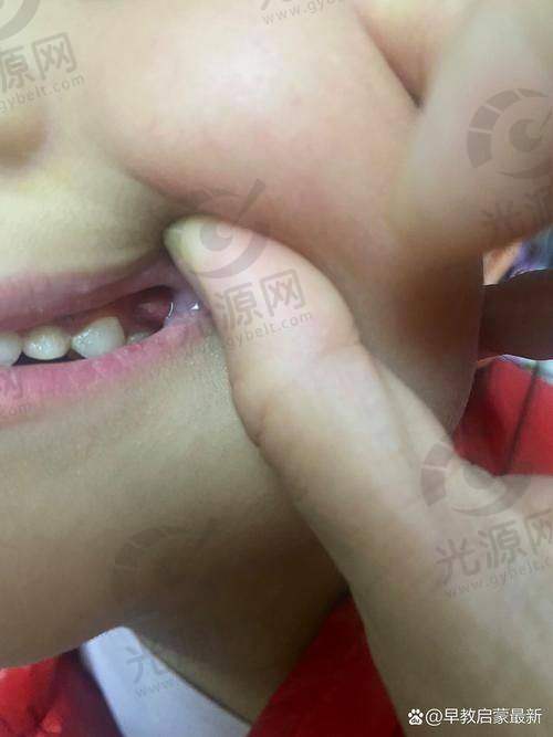 牙龈癌相关治疗方案的解析