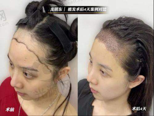 5000个毛囊植发价格详解：郑州地区植发费用及碧莲盛价格一览