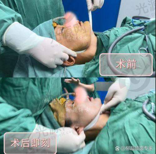 假体下巴上移手术费用详解