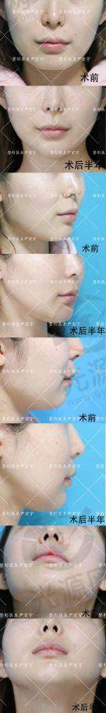 假体下巴移位原因及修复方法解析，避免假体上下移动的注意事项与手术费用详解
